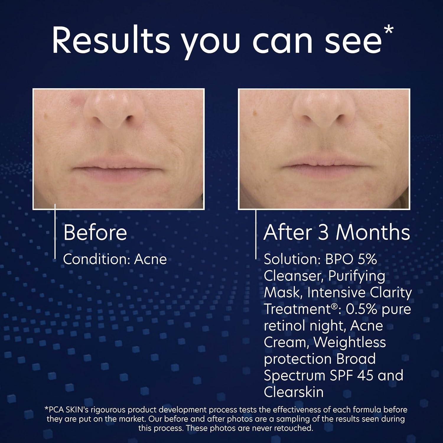 image:imagePCA SKIN 5 Benzoyl Peroxide Face Wash Foaming Acne Facial Cleanser for Oily and Acne Prone Skin Eliminates Existing Acne and Helps Prevent Future Breakouts Cleanses and Calms 70 Oz Bottle