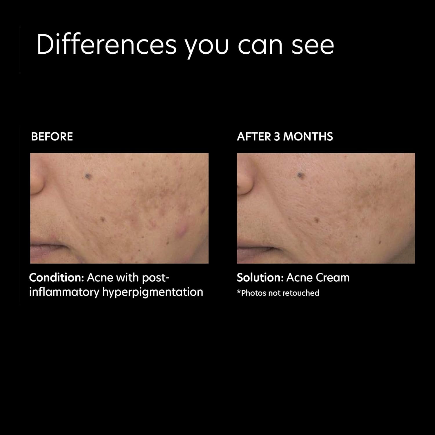 image:imagePCA SKIN Acne Treatment Cream for Face Daily Facial Spot Treatment with 5 Benzoyl Peroxide amp Hydrating Lactic Acid for AcneProne Skin 05 oz