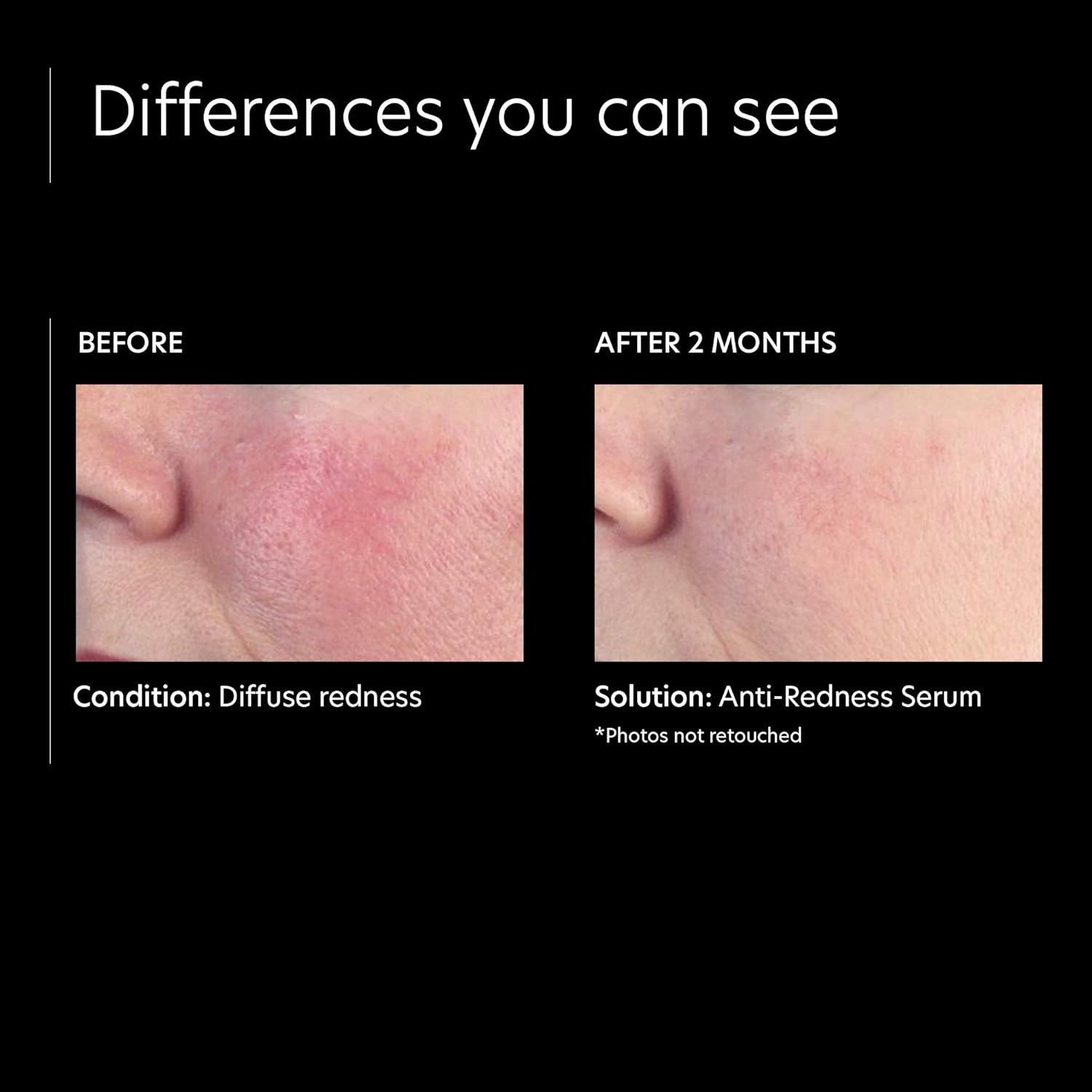 image:imagePCA SKIN Anti Redness Remover Face Serum OilFree Treatment Formulated with Advanced Calming Ingredients Improves Irritation amp Skin Tone 1 fl oz