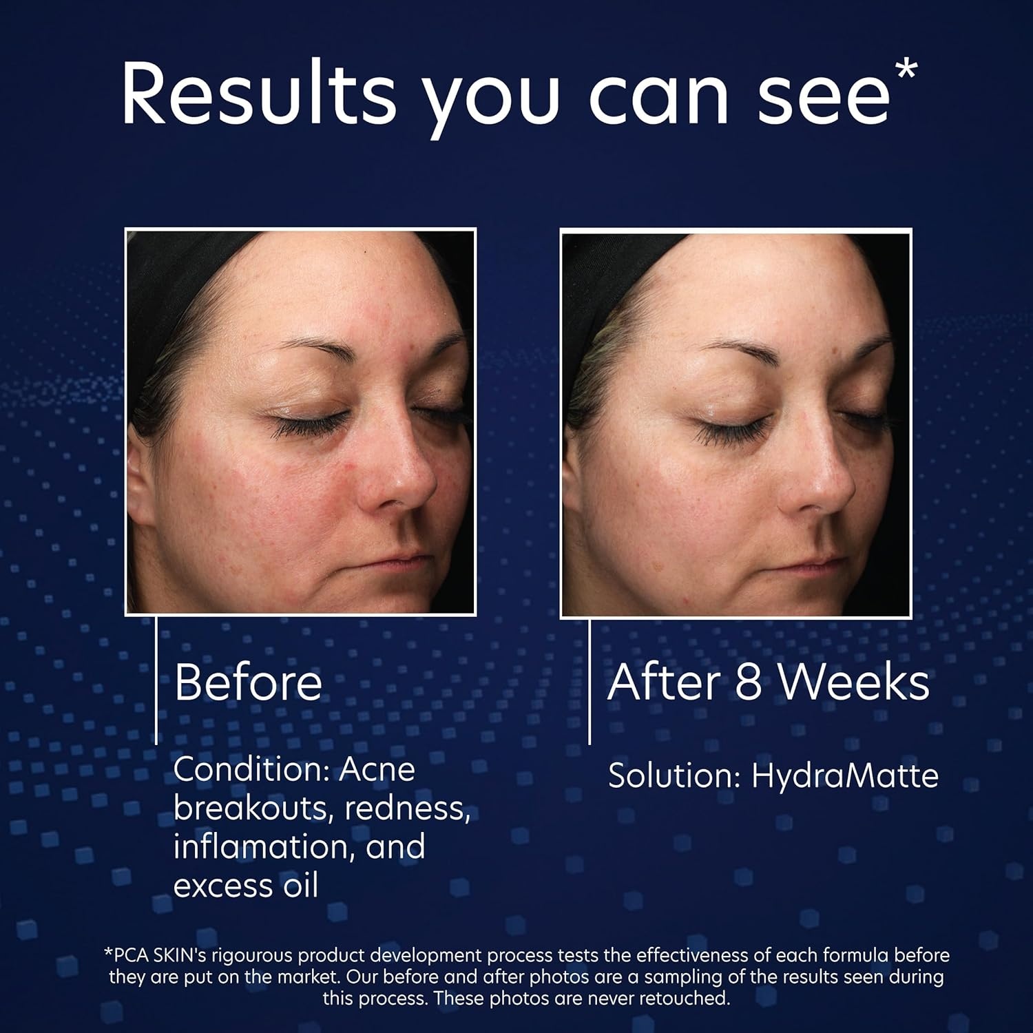 image:imagePCA SKIN HydraMatte Oil Control Moisturizer Face Moisturizer for Oily Skin Helps Reduce Oil and Promotes a Smoother Complexion Absorbs Quickly Great for Combination and Oily Skin 18 oz Jar