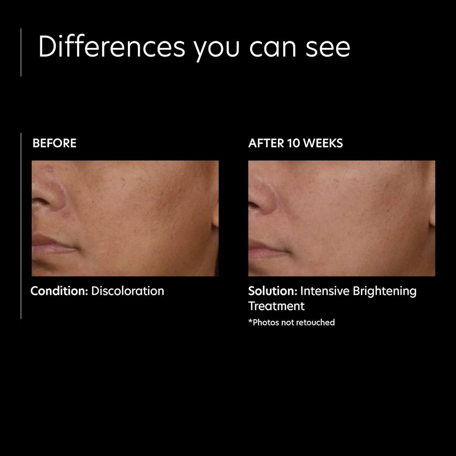 image:imagePCA SKIN Intensive Brightening Treatment 05 Pure Vitamin A Retinol Face Serum for Discoloration amp Dark Spots 1 oz