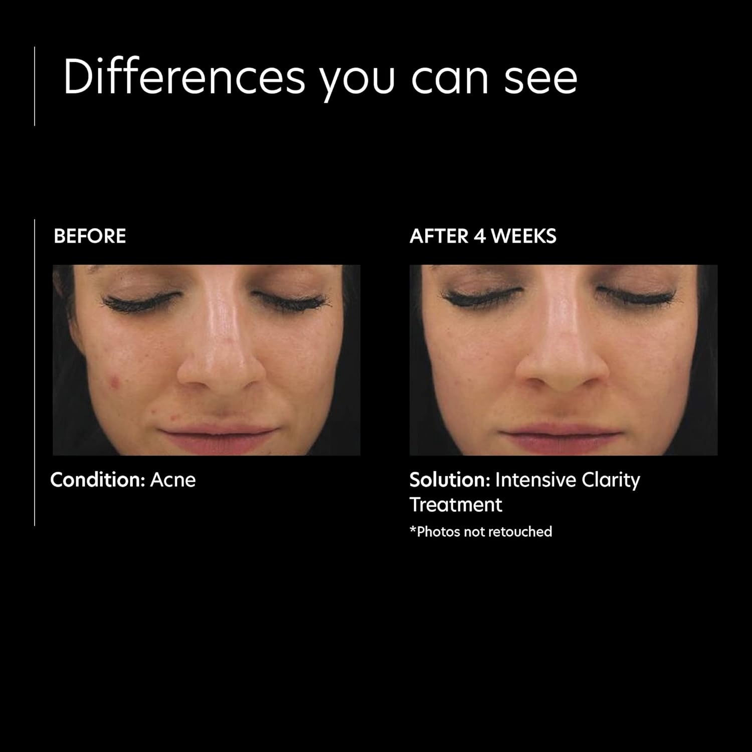 image:imagePCA SKIN Intensive Clarity Treatment 05 Pure Vitamin A Retinol amp 2 Salicylic Acid Face Serum for AcneProne Skin 1 oz