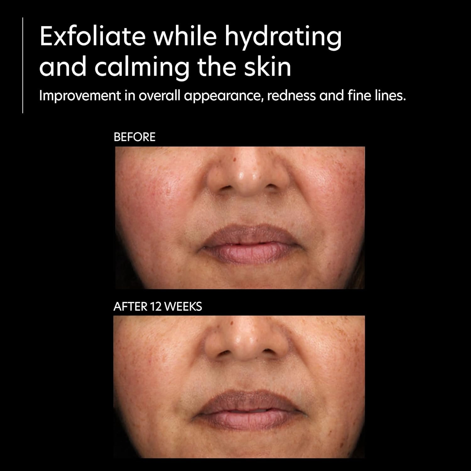 image:imagePCA SKIN Resurfacing Serum Gentle Exfoliating Facial Corrective with Lactic amp Glycolic Acid for Bright Even Skin 1 fl oz