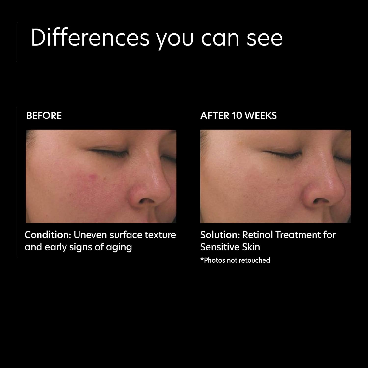 image:imagePCA SKIN Retinol Treatment for Sensitive Skin Anti Aging Face Serum to Gently Reduce Redness amp Minimize Fine Lines amp Wrinkles Contains Vitamin A amp Hydrating Niacinamide 1 oz