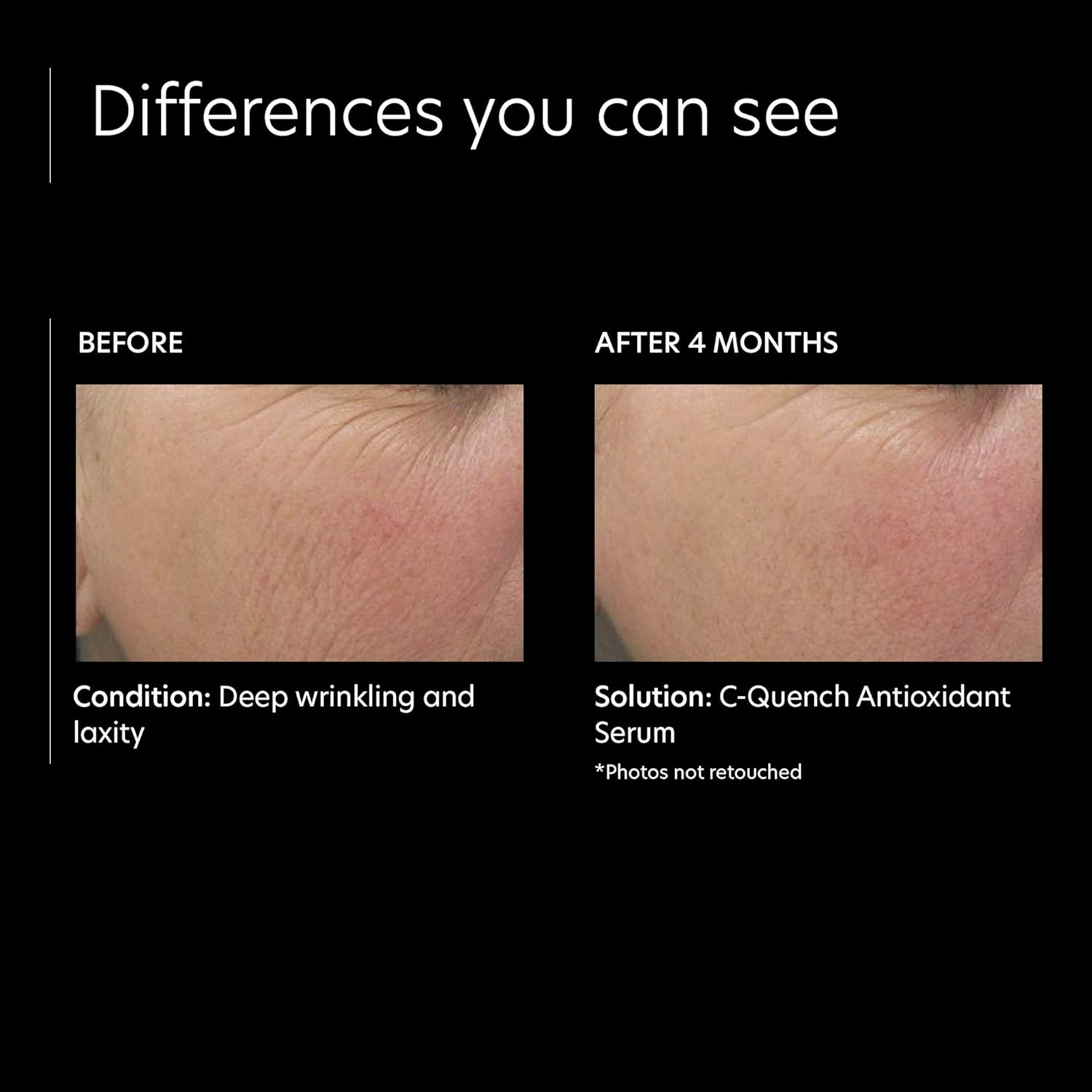 image:imagePCA SKIN Vitamin C Quench Antioxidant Protective Face Serum Anti Aging Hydrating Facial Corrector with Hyaluronic Acid for Fine Lines amp Wrinkles Recommended for Oily amp AcneProne Skin 1 fl oz